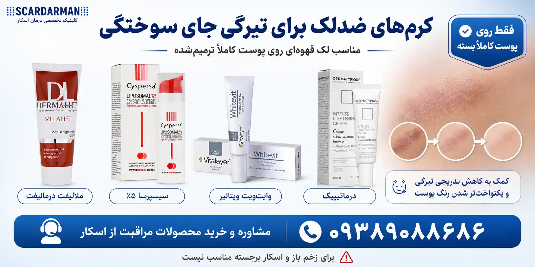 کرم&zwnj;های ضدلک برای تیرگی جای سوختگی