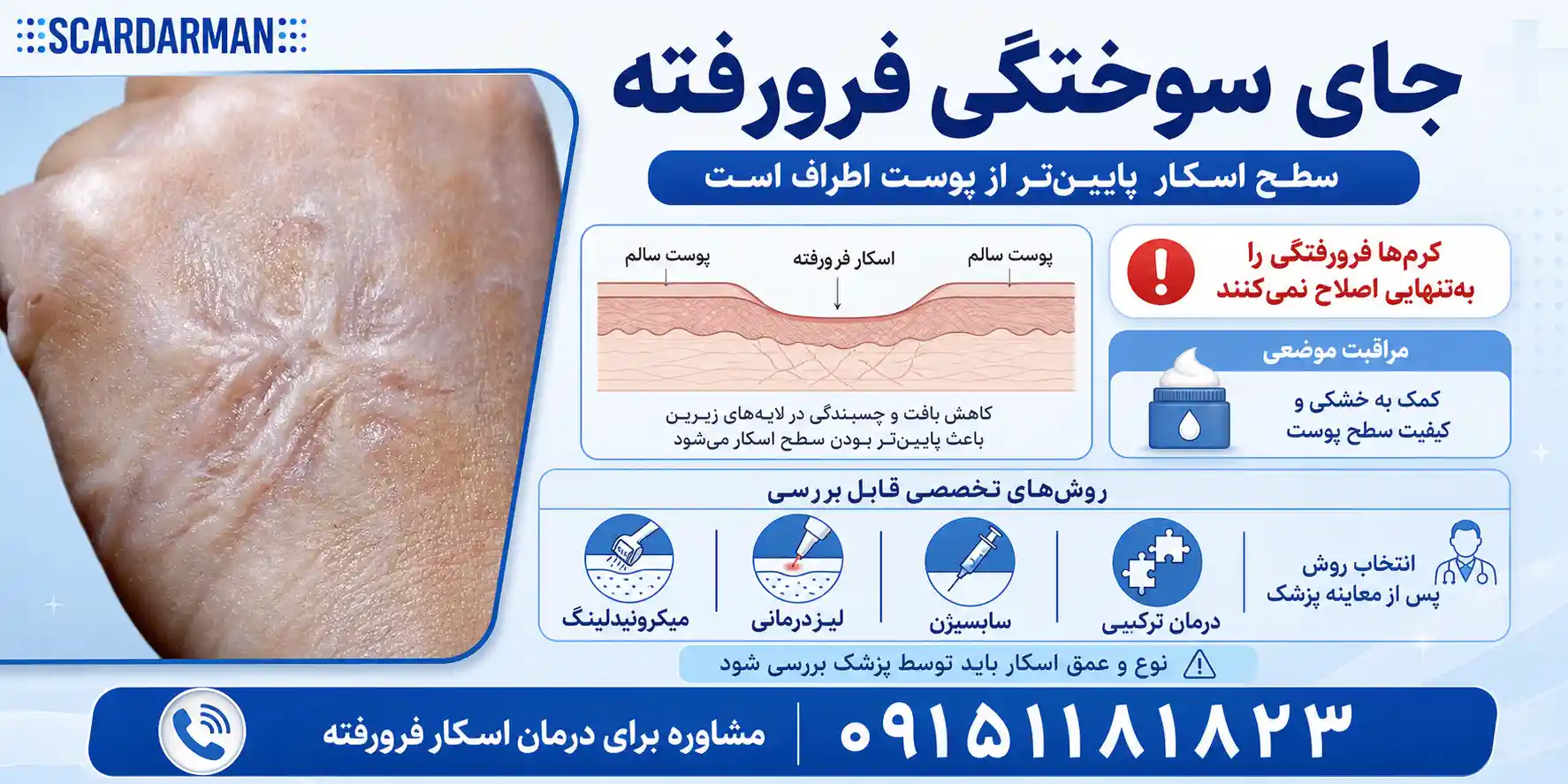 جای سوختگی فرورفته 