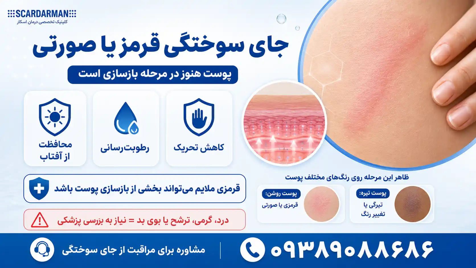جای سوختگی قرمز یا صورتی