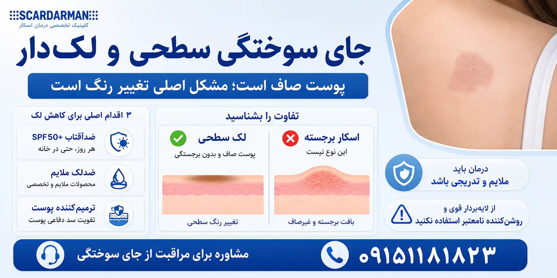 جای سوختگی سطحی و لک دار
