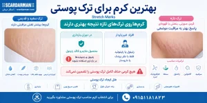 بهترین کرم برای ترک پوستی