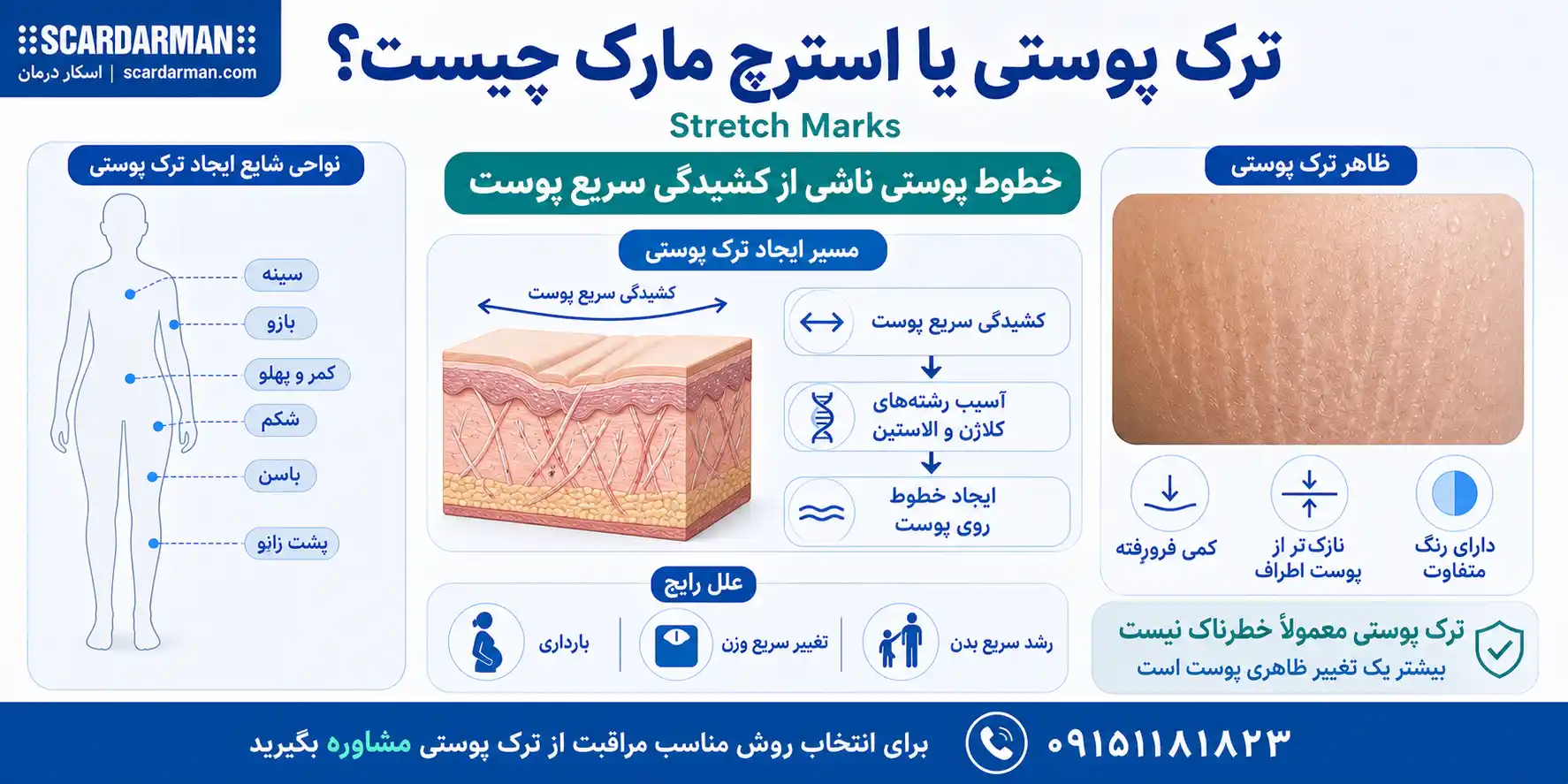 ترک پوستی یا استرچ مارک روی سطح پوست