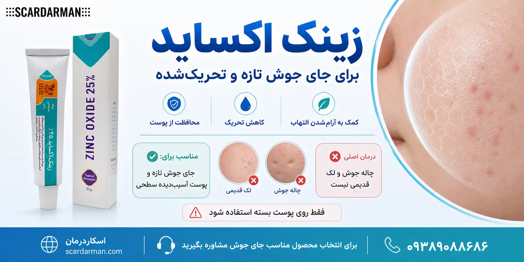 پماد زینک اکساید برای قرمزی و التهاب جای جوش