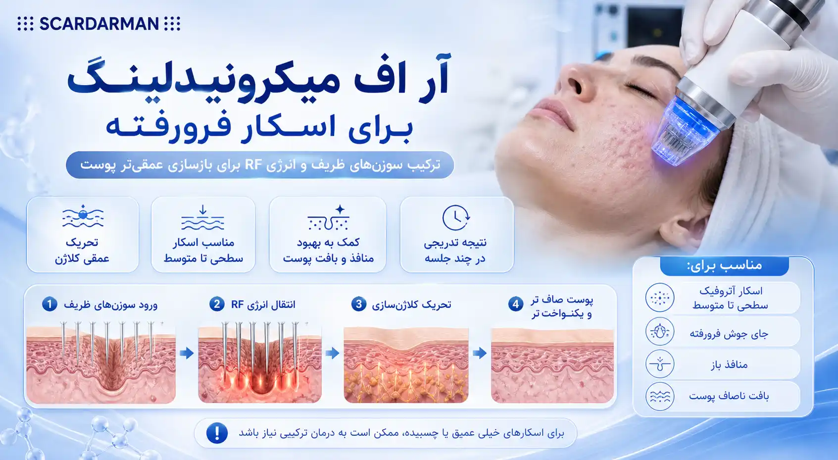 آر اف میکرونیدلینگ برای اسکار فرورفته