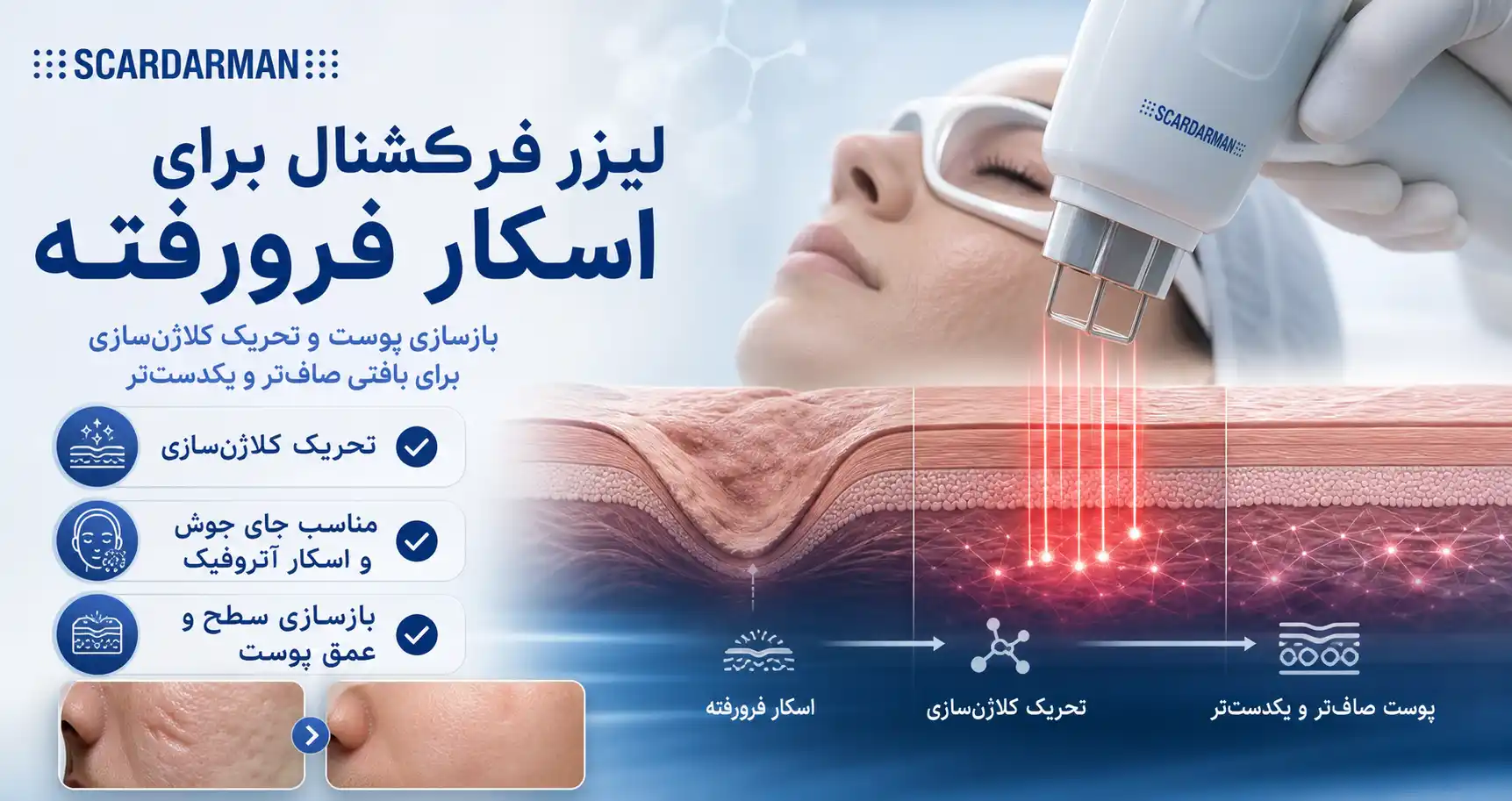 لیزر فرکشنال برای اسکار فرورفته