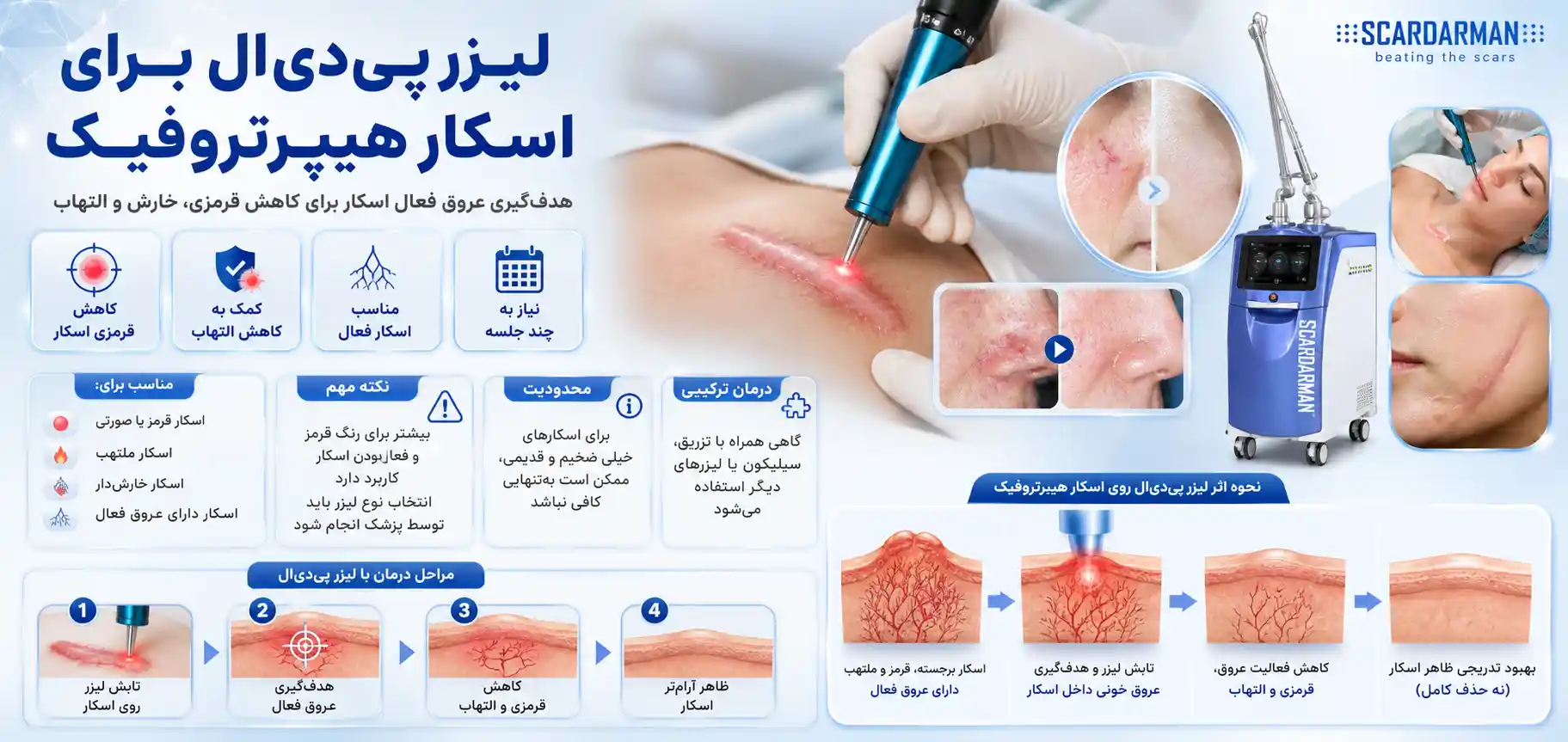 لیزر پی دی ال برای اسکار هیپرتروفیک