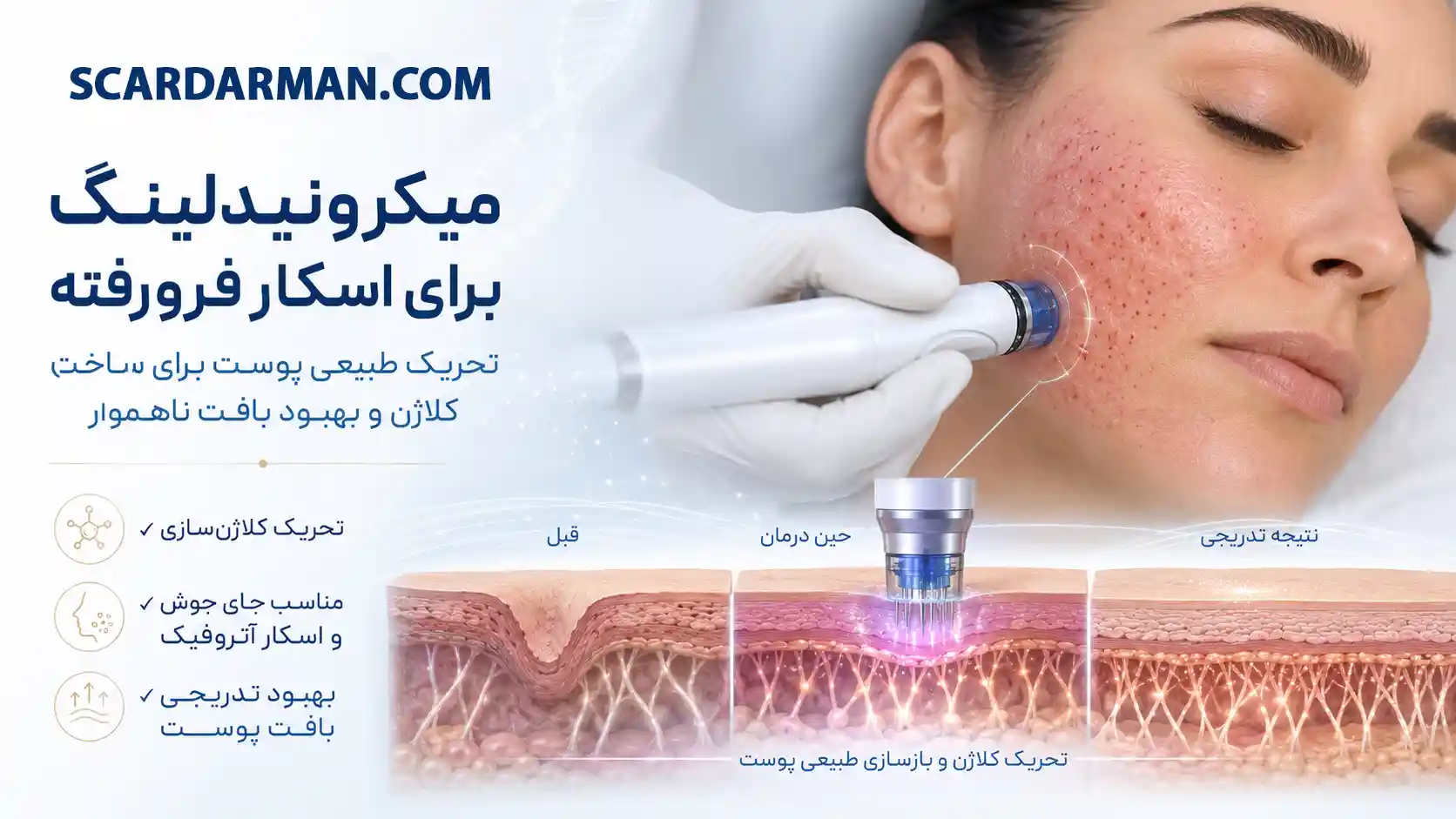 میکرونیدلینگ
