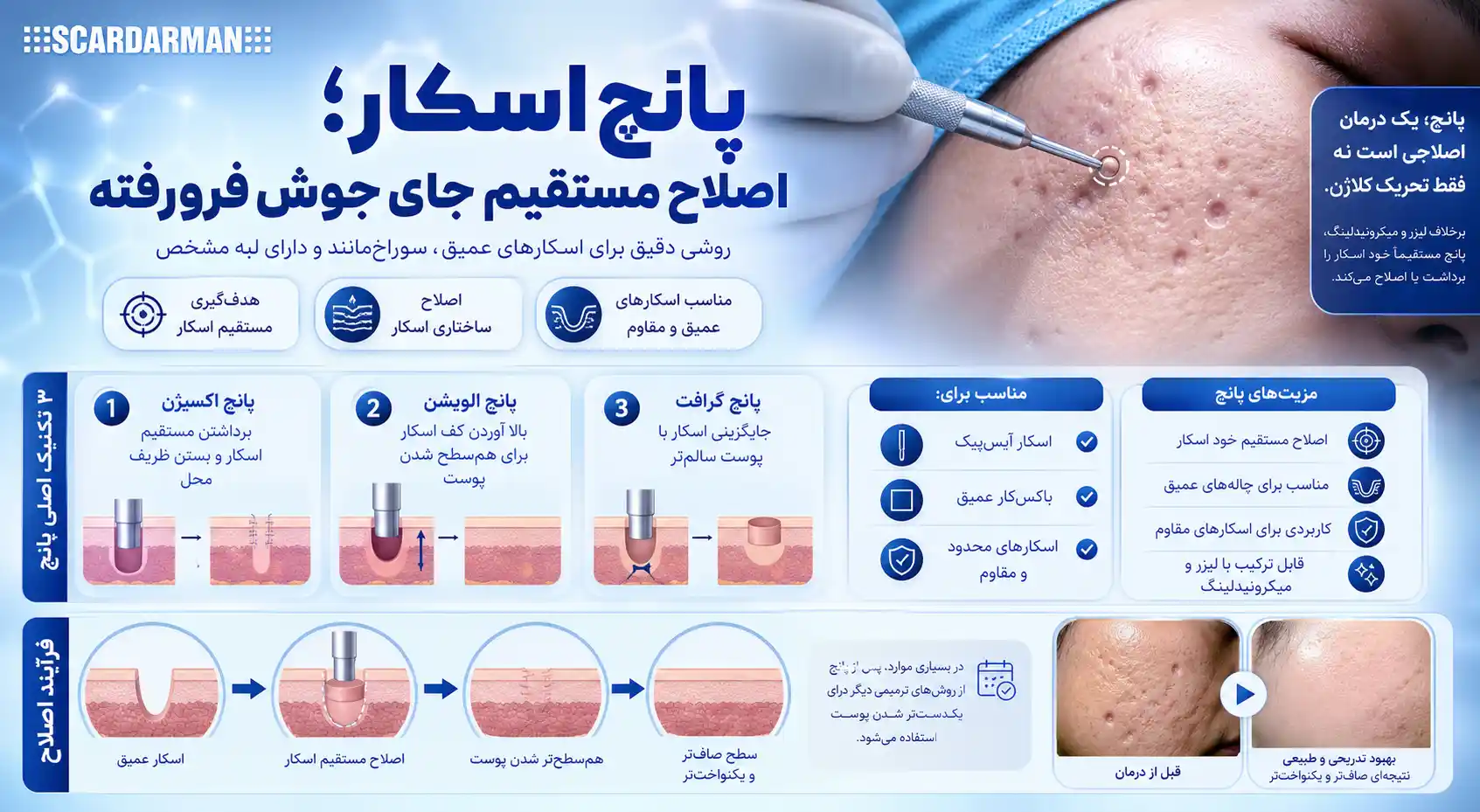 پانچ اسکار - اصلاح مستقیم جای جوش