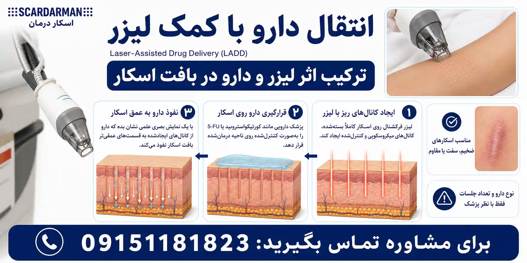 انتقال دارو با کمک لیزر