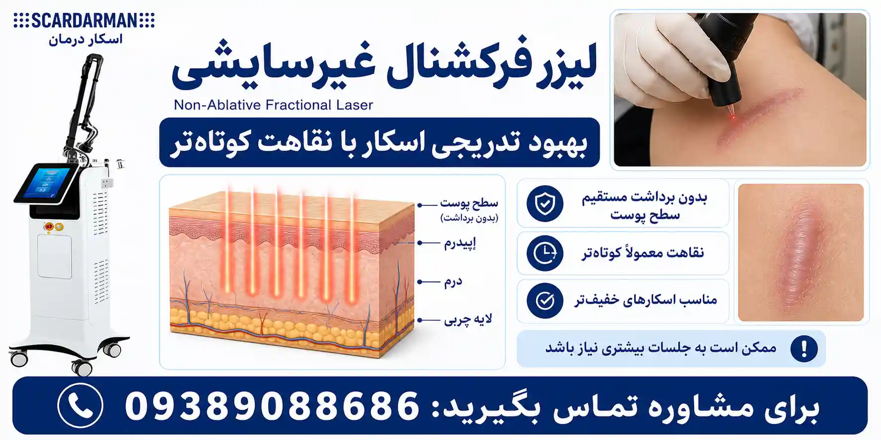 لیزر فرکشنال غیرسایشی