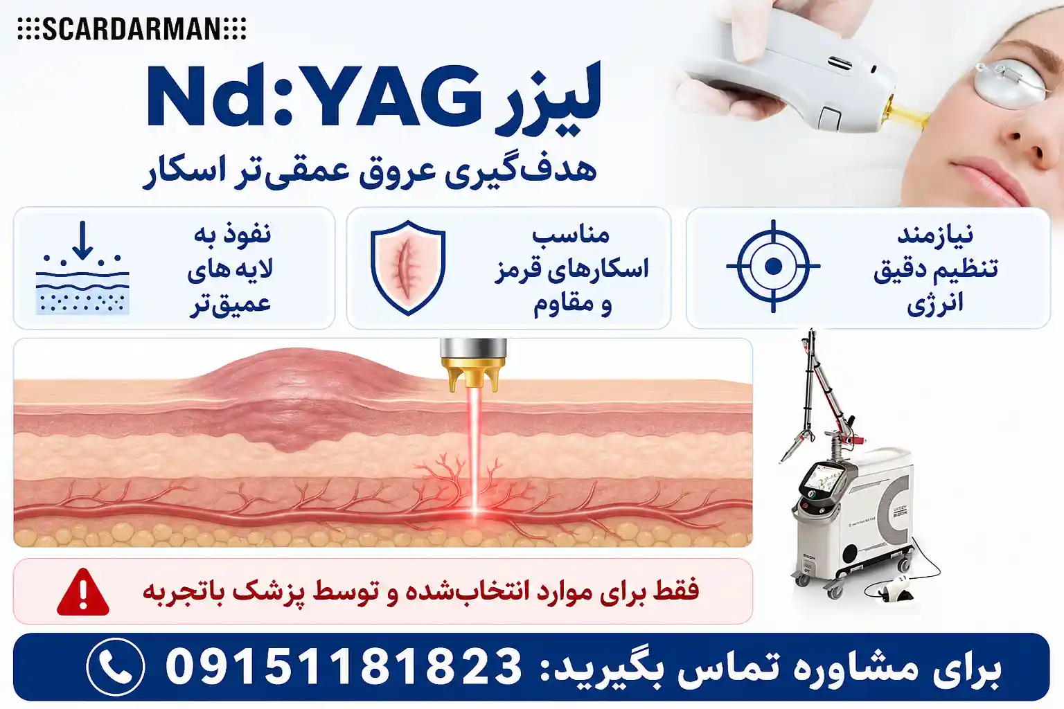 لیزر Nd:YAG