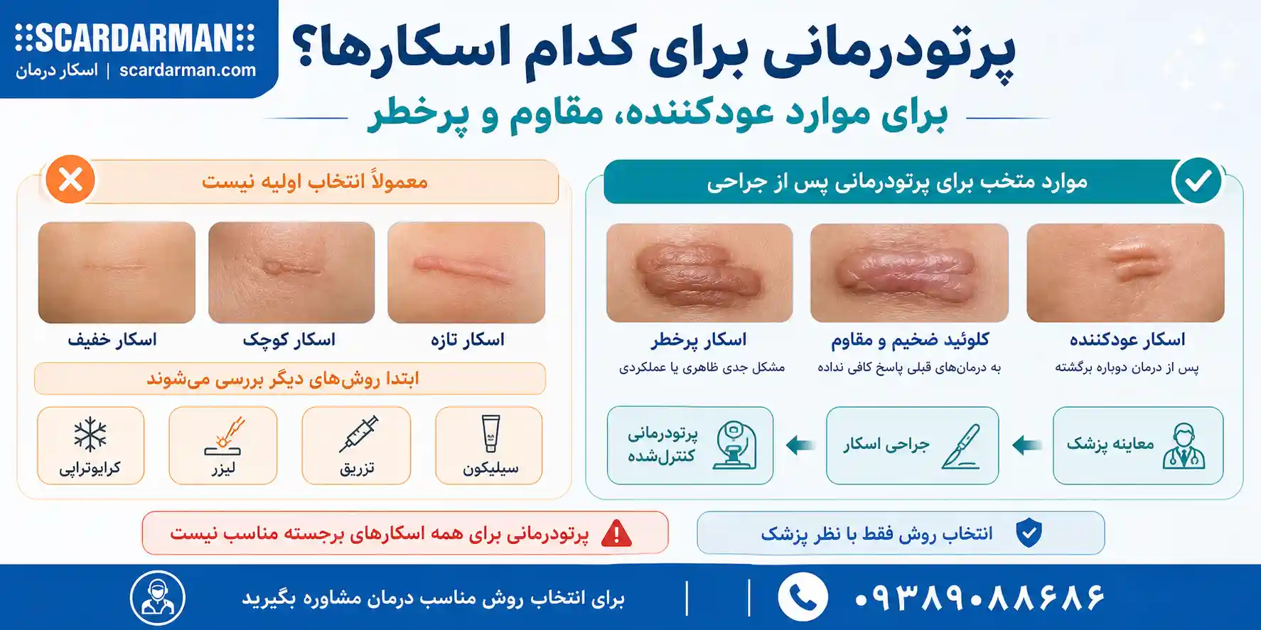 پرتودرمانی برای اسکارهای برجسته و کلوئیدی مقاوم به درمان