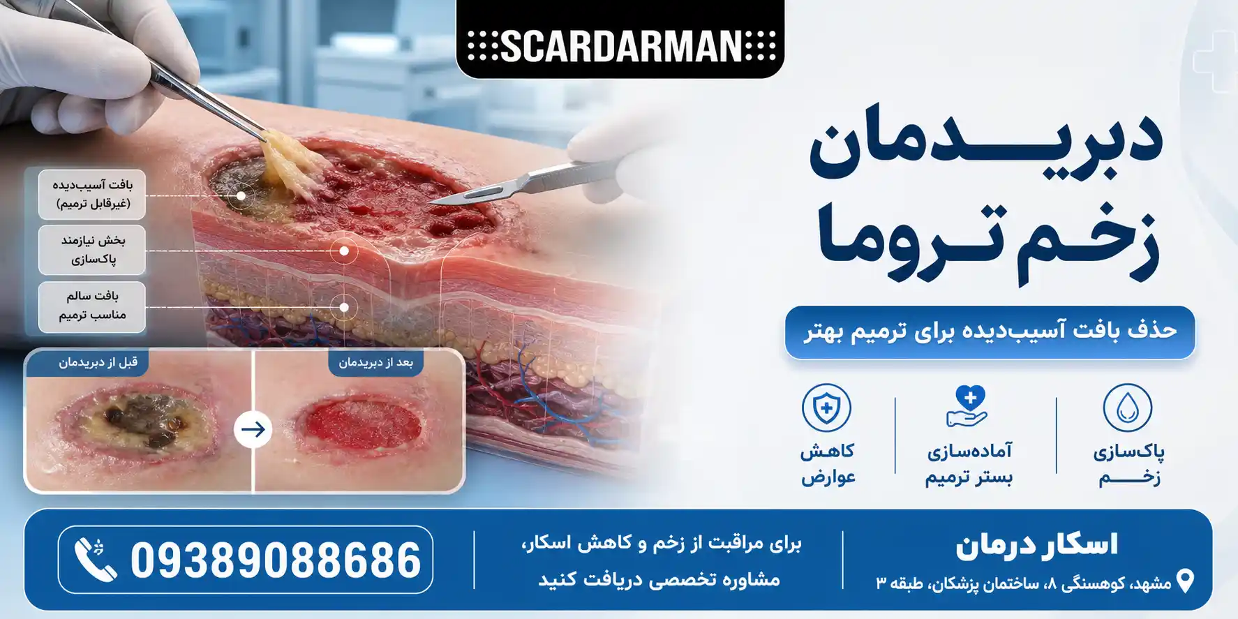 دبریدمان زخم ترومایی