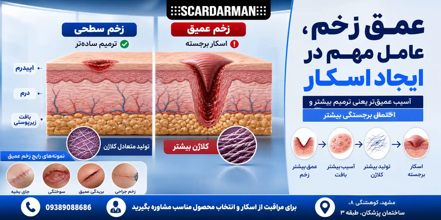 تأثیر عمق زخم بر برجسته شدن جای آن